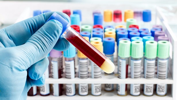 دانشمندان با آزمایش خون، به تشخیص سرطان نزدیکتر شدند - تکفارس 