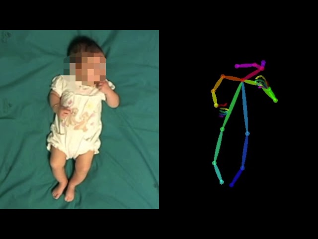استفاده از هوش مصنوعی برای تشخیص بیماری عصبی در نوزادان - تکفارس 