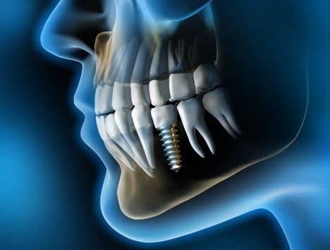 ایمپلنت دیجیتال دندان: یکی از روش‌های نوین ایمپلنت دندان - تکفارس 