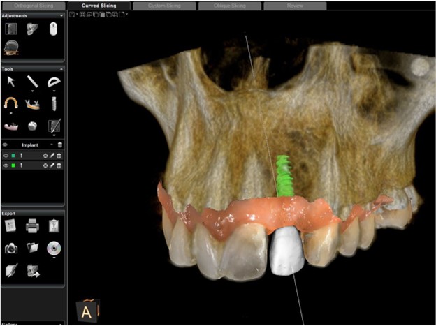 ایمپلنت دیجیتال دندان: یکی از روش‌های نوین ایمپلنت دندان - تکفارس 