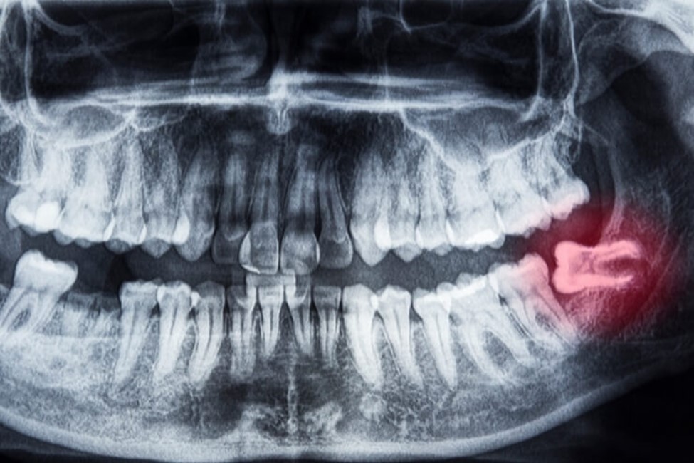 چه زمانی کشیدن دندان عقل ضروری است؟  - تکفارس 