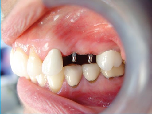 مینی ایمپلنت دندان: مزایا، عوارض و ماندگاری آن   - تکفارس 
