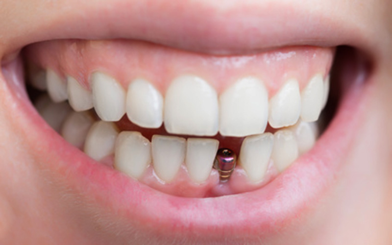 مینی ایمپلنت دندان: مزایا، عوارض و ماندگاری آن   - تکفارس 