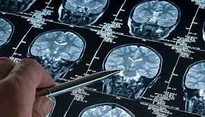 تومور مغزی چیست و انواع آن کدام است ؟  - تکفارس 